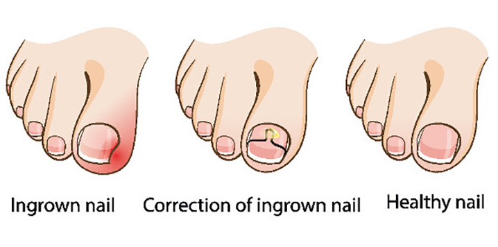 toenail brace for ingrown nails